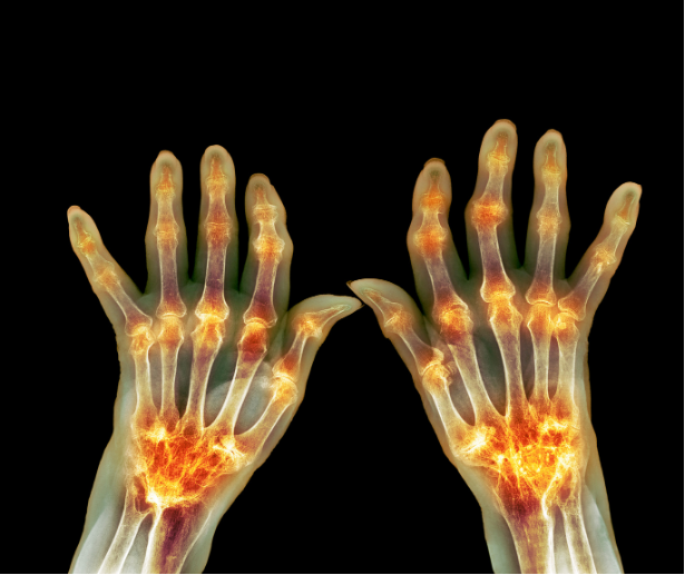 NIH Names mBIOTA Labs’ Research Proposal for Rheumatoid Arthritis Among Winners for its Nutrition for Our Immune System Health (NOURISH) Autoimmunity Challenge